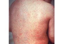 Mongolia confirms imported case of measles