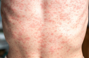 Texas confirms first US death in measles outbreak