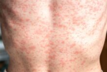 Health alert issued for measles outbreak in Australia’s Victoria state