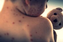Measles health alert issued for Sydney