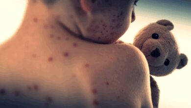 Measles health alert issued for Sydney
