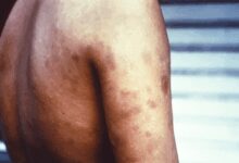 Maha govt to launch statewide drive against leprosy from November 17