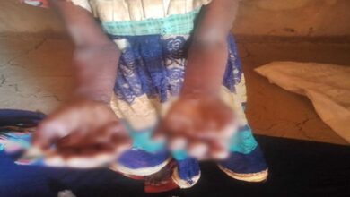 Digvijaya Singh flags skin disease outbreak among children in MP’s Betul, seeks urgent action