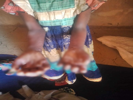 Digvijaya Singh flags skin disease outbreak among children in MP’s Betul, seeks urgent action Digvijaya Singh flags skin disease outbreak among children in MP’s Betul, seeks urgent action