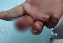 Bloody brawl at samosa-cutlet shop in Mumbai: Customer bites off shopkeeper’s finger, accused arrested