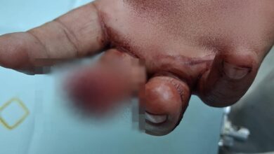 Bloody brawl at samosa-cutlet shop in Mumbai: Customer bites off shopkeeper’s finger, accused arrested