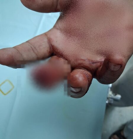 Bloody brawl at samosa-cutlet shop in Mumbai: Customer bites off shopkeeper’s finger, accused arrested Bloody brawl at samosa-cutlet shop in Mumbai: Customer bites off shopkeeper’s finger, accused arrested