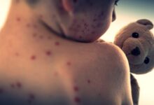 Measles claims lives of 71 children in Pakistan in four months of 2026