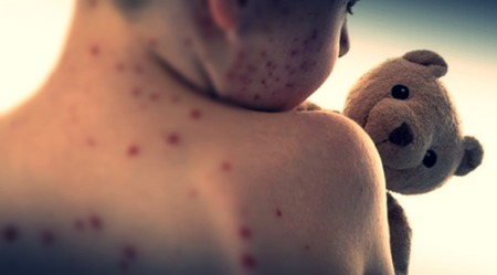 Bangladesh measles outbreak death toll climbs to 499 after 11 more fatalities Bangladesh measles outbreak death toll climbs to 499 after 11 more fatalities
