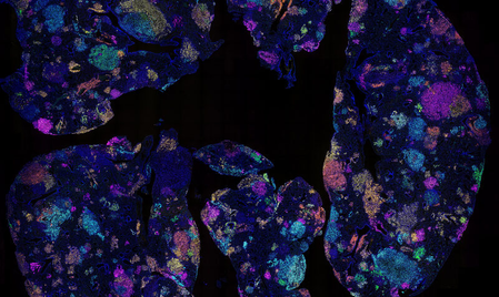 Australian study identifies early blood marker for lung cancer risk Australian study identifies early blood marker for lung cancer risk