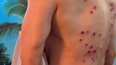 Gaurav Khanna shows painful laser burn marks on his back from ‘Khatron Ke Khiladi’ task