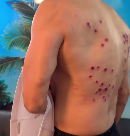 Gaurav Khanna shows painful laser burn marks on his back from ‘Khatron Ke Khiladi’ task Gaurav Khanna shows painful laser burn marks on his back from ‘Khatron Ke Khiladi’ task
