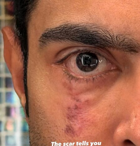 Abhishek Banerjee’s ‘scar’ post sparks political buzz amid US eye treatment Abhishek Banerjee’s ‘scar’ post sparks political buzz amid US eye treatment