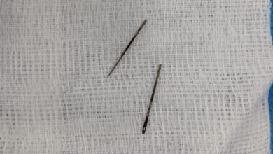 Gujarat: 12-year-old swallows metal pin; AIIMS Rajkot doctors remove it without surgery