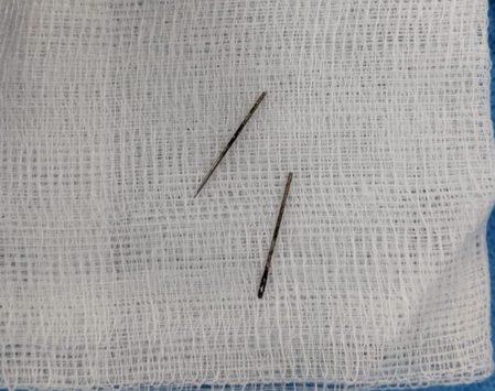 Gujarat: 12-year-old swallows metal pin; AIIMS Rajkot doctors remove it without surgery Gujarat: 12-year-old swallows metal pin; AIIMS Rajkot doctors remove it without surgery
